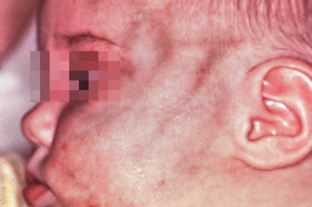 Schwere Hämatome im Gesicht eines Kleinkindes