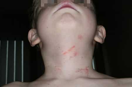 Schwere Würgemale am Hals eines Kindes